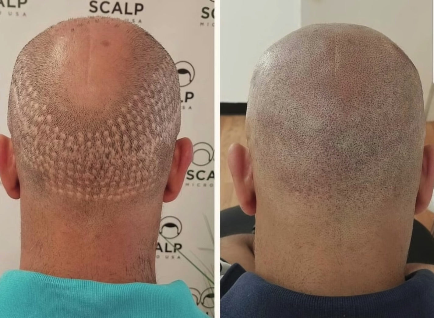scalp micropigmentation hair transplant scar training