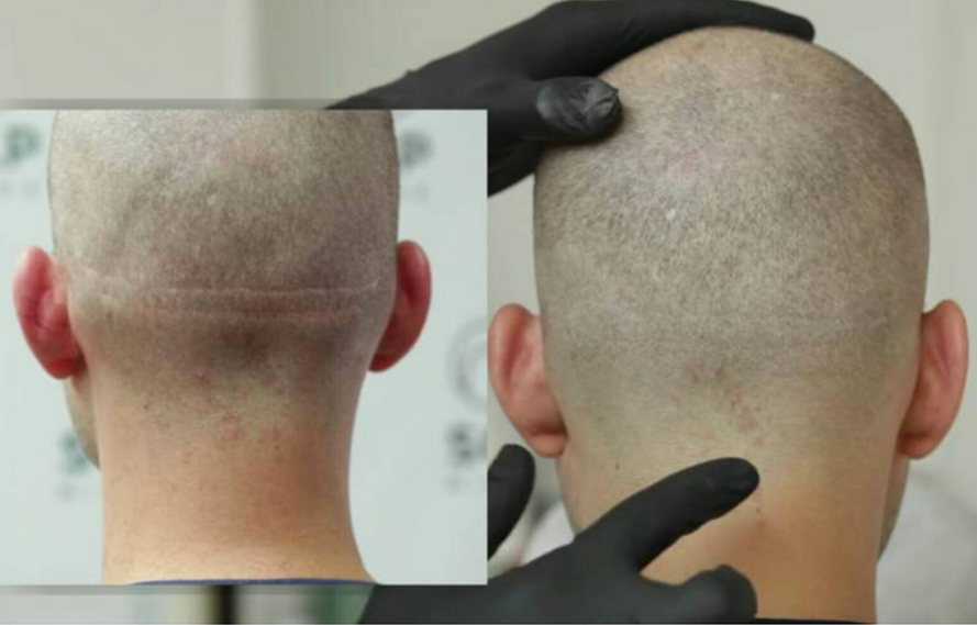 scalp micropigmentation scar training online